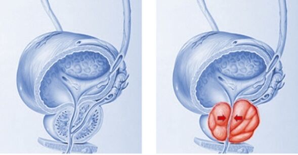 zdravá a zanícená prostata s prostatitidou